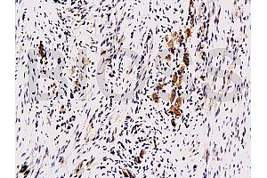 Formalin-fixed and paraffin embedded human colon carcinoma with Anti-Maspin Polyclonal Antibody, Unconjugated (ABIN728233) at 1:200, followed by conjugation to the secondary antibody and DAB staining