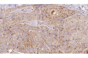 ABIN6267101 at 1/100 staining Human thyroid cancer tissue by IHC-P.