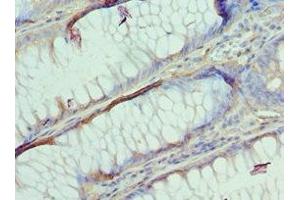 Immunohistochemistry of paraffin-embedded human colon cancer using ABIN7144363 at dilution of 1:100 (AP2B1 antibody  (AA 738-937))