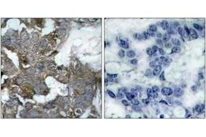 Immunohistochemistry analysis of paraffin-embedded human breast carcinoma tissue, using IkappaB-alpha (Ab-32/36) Antibody. (NFKBIA antibody  (AA 15-64))