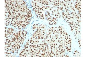 Formalin-fixed, paraffin-embedded human Melanoma stained with SOX10 Mouse Monoclonal Antibody (SOX10/991). (SOX10 antibody  (AA 115-269))