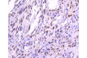 Paraformaldehyde-fixed, paraffin embedded human breast carcinoma, Antigen retrieval by boiling in sodium citrate buffer (pH6) for 15min, Block endogenous peroxidase by 3% hydrogen peroxide for 30 minutes, Blocking buffer (normal serum) at 37°C for 20min, Antibody incubation with PKC alpha(T638) (4B3) Monoclonal Antibody  at 1:50 overnight at 4°C, followed by a conjugated secondary and DAB staining. (PKC alpha antibody  (pThr638))