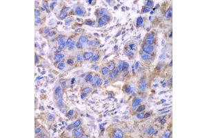 Immunohistochemistry of paraffin-embedded human esophageal cancer using SDHA antibody. (SDHA antibody  (AA 385-664))