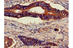 Immunohistochemistry of paraffin-embedded human colon cancer using ABIN7144852 at dilution of 1:100 (ATP5F1D antibody  (AA 32-158))