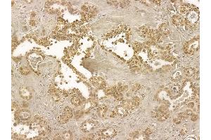 ALS2CR1 Mouse Monoclonal Antibody at 1/100 staining human ovarian cancer by IHC-P.