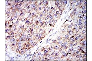 Immunohistochemical analysis of paraffin-embedded kidney cancer tissues using G6PD mouse mAb with DAB staining. (Glucose-6-Phosphate Dehydrogenase antibody)