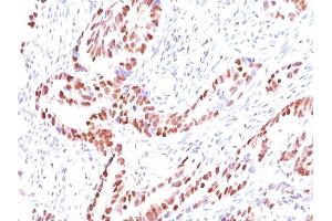 Formalin-fixed, paraffin-embedded human Colon Carcinoma stained with p57 Mouse Monoclonal Antibody (KIP2/880).