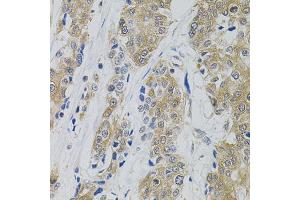 Immunohistochemistry of paraffin-embedded human prostate cancer using DNM2 antibody (ABIN5970189) (40x lens).