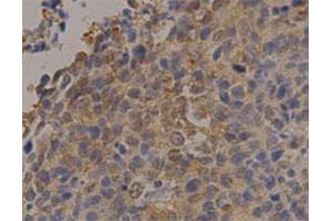 Immunohistochemical staining of human lung cancer with PGK1 monoclonal antibody, clone 14  at 1:100 dilution. (PGK1 antibody)