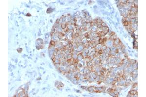 Formalin-fixed, paraffin-embedded human Prostate Carcinoma stained with STAT2 Mouse Monoclonal Antibody (STAT2/2650). (STAT2 antibody)