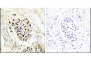 Immunohistochemistry analysis of paraffin-embedded human breast carcinoma tissue, using MED1 Antibody. (MED1 antibody  (AA 641-690))