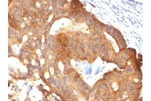 Formalin-fixed, paraffin-embedded Colon Carcinoma stained with Cytokeratin 8 Mouse Monoclonal Antibody (B22. (KRT8 antibody)