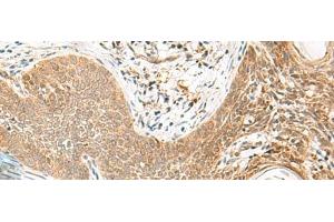 Immunohistochemistry of paraffin-embedded Human esophagus cancer tissue using ORC4 Polyclonal Antibody at dilution of 1:80(x200) (ORC4 antibody)