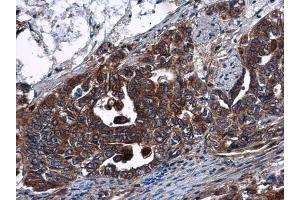 IHC-P Image DNase I antibody [N1C3] detects DNase I protein at cytoplasm in human cervical carcinoma by immunohistochemical analysis. (DNASE1 antibody)