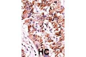 Formalin-fixed and paraffin-embedded human cancer tissue reacted with the primary antibody, which was peroxidase-conjugated to the secondary antibody, followed by AEC staining. (CHEK1 antibody  (pSer317))