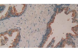 Detection of TIMP1 in Human Prostate Tissue using Polyclonal Antibody to Tissue Inhibitors Of Metalloproteinase 1 (TIMP1) (TIMP1 antibody  (AA 25-207))