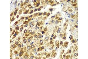 Immunohistochemistry of paraffin-embedded Human liver cancer using SND1 Polyclonal Antibody at dilution of 1:100 (40x lens). (SND1 antibody)