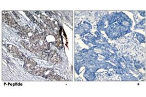 Immunohistochemical analysis of paraffin-embedded human breast carcinoma tissue using TP53 (phospho S6) polyclonal antibody . (p53 antibody  (pSer6))