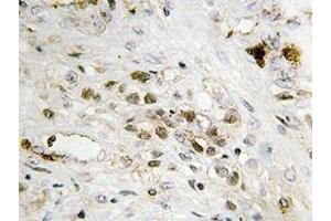 Immunohistochemistry analyzes of FoxC1/2 antibody in paraffin-embedded human prostate carcinoma tissue. (FOXC1 antibody)