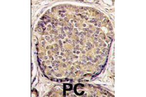 Formalin-fixed and paraffin-embedded human prostate carcinoma tissue reacted with PIK3CB polyclonal antibody  , which was peroxidase-conjugated to the secondary antibody, followed by DAB staining.