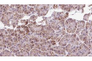 ABIN6273250 at 1/100 staining Human pancreas cancer tissue by IHC-P. (GPD2 antibody  (N-Term))