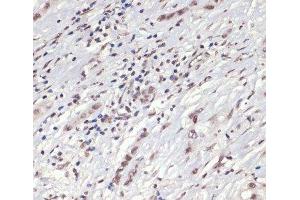 Immunohistochemistry of paraffin-embedded Human liver cancer using Phospho-Jak2(Y1007/1008) Polyclonal Antibody at dilution of 1:200 (40x lens).