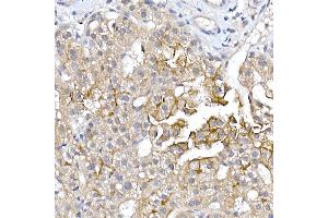 Immunohistochemistry of paraffin-embedded human liver cancer using  Rabbit pAb (ABIN6133588, ABIN6137055, ABIN6137056 and ABIN6224634) at dilution of 1:150 (40x lens). (AQP9 antibody  (AA 50-150))
