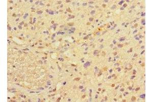 Immunohistochemistry of paraffin-embedded human glioma using ABIN7165067 at dilution of 1:100 (PRMT3 antibody  (AA 311-529))