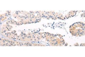 Immunohistochemistry of paraffin-embedded Human liver cancer tissue using ANAPC15 Polyclonal Antibody at dilution of 1:50(x200) (ANAPC15 antibody)