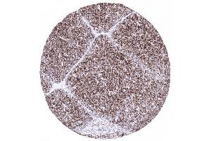 A strong CD1a immunostaining is seen in 80 of small lymphocytes in the thymic cortex (Recombinant CD1a antibody)