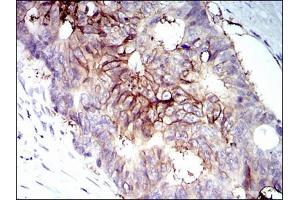 Immunohistochemical analysis of paraffin-embedded rectum cancer tissues using IGF1R antibody with DAB staining. (IGF1R antibody)