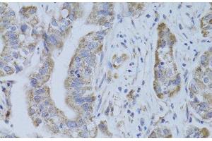 Immunohistochemistry of paraffin-embedded Human liver cancer using CDKN1A Polyclonal Antibody at dilution of 1:100 (40x lens). (p21 antibody)