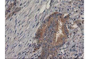 Immunohistochemical staining of paraffin-embedded Adenocarcinoma of Human colon tissue using anti-BCAR1 mouse monoclonal antibody. (BCAR1 antibody)