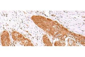 Immunohistochemistry of paraffin-embedded Human esophagus cancer tissue using FDPS Polyclonal Antibody at dilution of 1:60(x200)