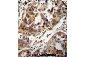CCDC17 antibody (C-term) immunohistochemistry analysis in formalin fixed and paraffin embedded human breast carcinoma followed by peroxidase conjugation of the secondary antibody and DAB staining. (CCDC17 antibody  (C-Term))