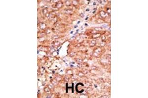 Formalin-fixed and paraffin-embedded human cancer tissue reacted with the primary antibody, which was peroxidase-conjugated to the secondary antibody, followed by AEC staining. (CCBP2 antibody  (C-Term))