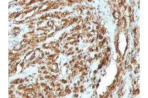 Formalin-fixed, paraffin-embedded human rhabdomyosarcoma stained with pan Muscle Actin antibody (HHF35 + MSA/953) (Pan Muscle Actin antibody)