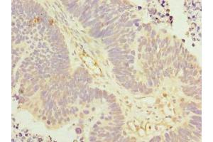 Immunohistochemistry of paraffin-embedded human ovarian cancer using ABIN7157306 at dilution of 1:100 (KLHDC5 antibody  (AA 1-410))