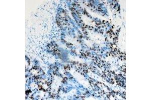 Immunohistochemical analysis of DACH1 staining in human colon cancer formalin fixed paraffin embedded tissue section. (DACH1 antibody)