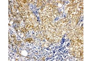 IHC-P: Vinculin antibody testing of human breast cancer tissue (Vinculin antibody  (AA 173-188))