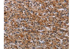 The image on the left is immunohistochemistry of paraffin-embedded Human prostate cancer tissue using ABIN7190614(F2RL2 Antibody) at dilution 1/30, on the right is treated with synthetic peptide. (F2RL2 antibody)