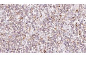 ABIN6273206 at 1/100 staining Human lymph cancer tissue by IHC-P. (CCDC93 antibody  (C-Term))