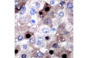 Immunohistochemical analysis of SULT2B1 staining in human liver cancer formalin fixed paraffin embedded tissue section.