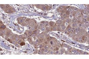 ABIN6269009 at 1/100 staining Human liver cancer tissue by IHC-P. (SLC2A3 antibody  (C-Term))