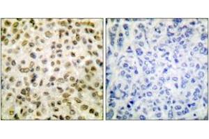 Immunohistochemistry analysis of paraffin-embedded human breast carcinoma tissue, using Histone H1 (Acetyl-Lys25) Antibody. (Histone H1 antibody  (acLys25))
