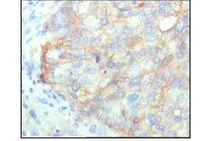 Immunohistochemical analysis of paraffin-embedded human cervical carcinoma, showing cytoplasmic localization with DAB staining using KARS mouse mAb.
