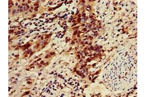 Immunohistochemistry of paraffin-embedded human bladder cancer using ABIN7176497 at dilution of 1:100 (ZNF695 antibody  (AA 1-88))