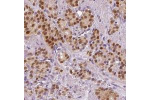 IHC analysis of paraffin-embedded human prostate cancer tissue, using SPOP antibody (1/200 dilution). (SPOP-B antibody)