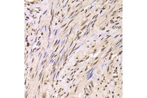 Immunohistochemistry of paraffin-embedded Human adenomyosis using SNRPA antibody at dilution of 1:100 (x400 lens). (SNRPA1 antibody)