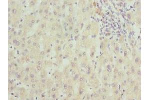 Immunohistochemistry of paraffin-embedded human liver cancer using ABIN7166597 at dilution of 1:100 (FAM20A antibody  (AA 140-240))
